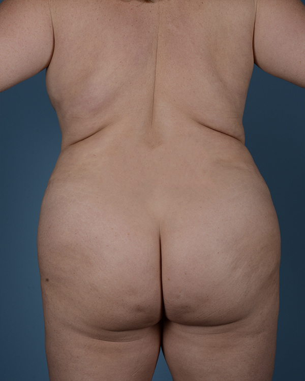 Liposuction Before and After | Dr. Thomas Hubbard