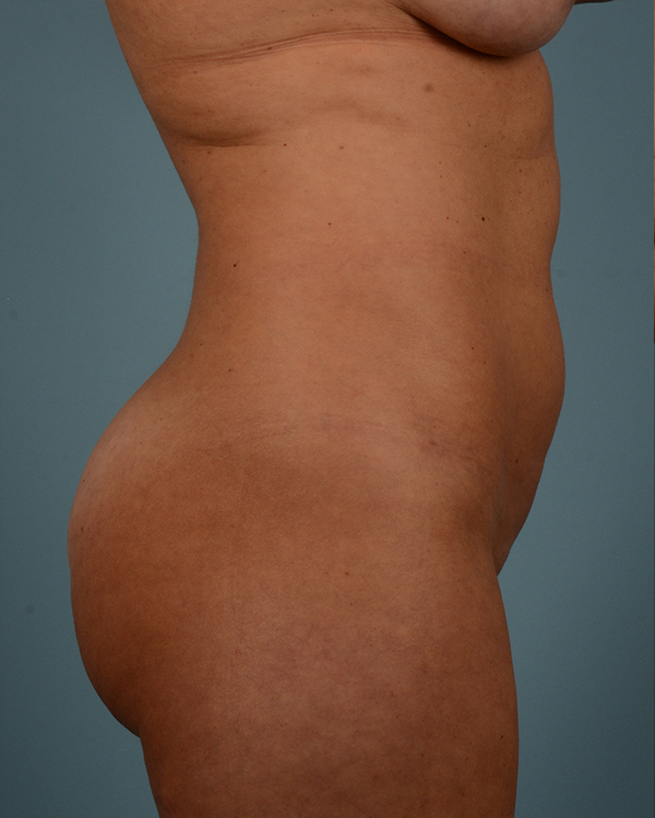 Liposuction Before and After | Dr. Thomas Hubbard