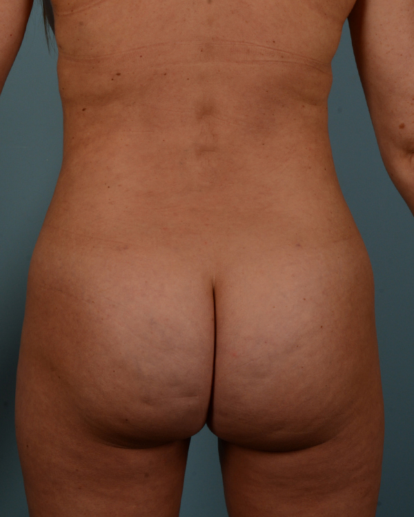 Liposuction Before and After | Dr. Thomas Hubbard