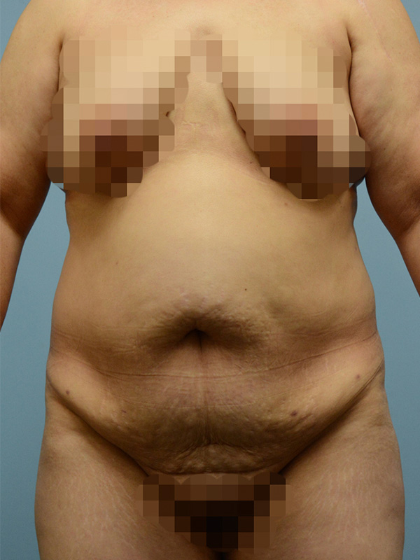 Liposuction Before and After | Dr. Thomas Hubbard