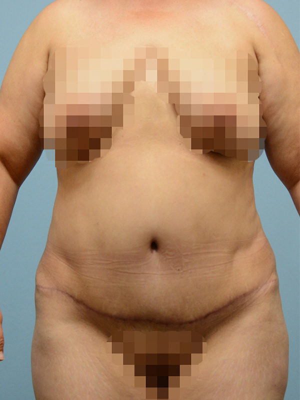 Liposuction Before and After | Dr. Thomas Hubbard