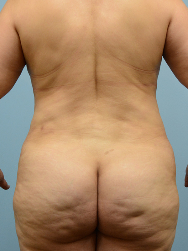 Liposuction Before and After | Dr. Thomas Hubbard