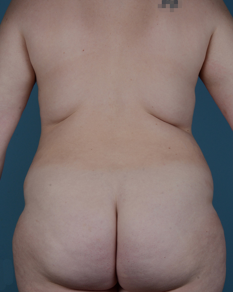 Liposuction Before and After | Dr. Thomas Hubbard