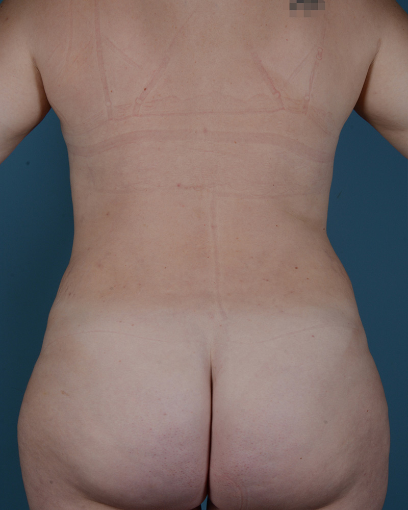 Liposuction Before and After | Dr. Thomas Hubbard