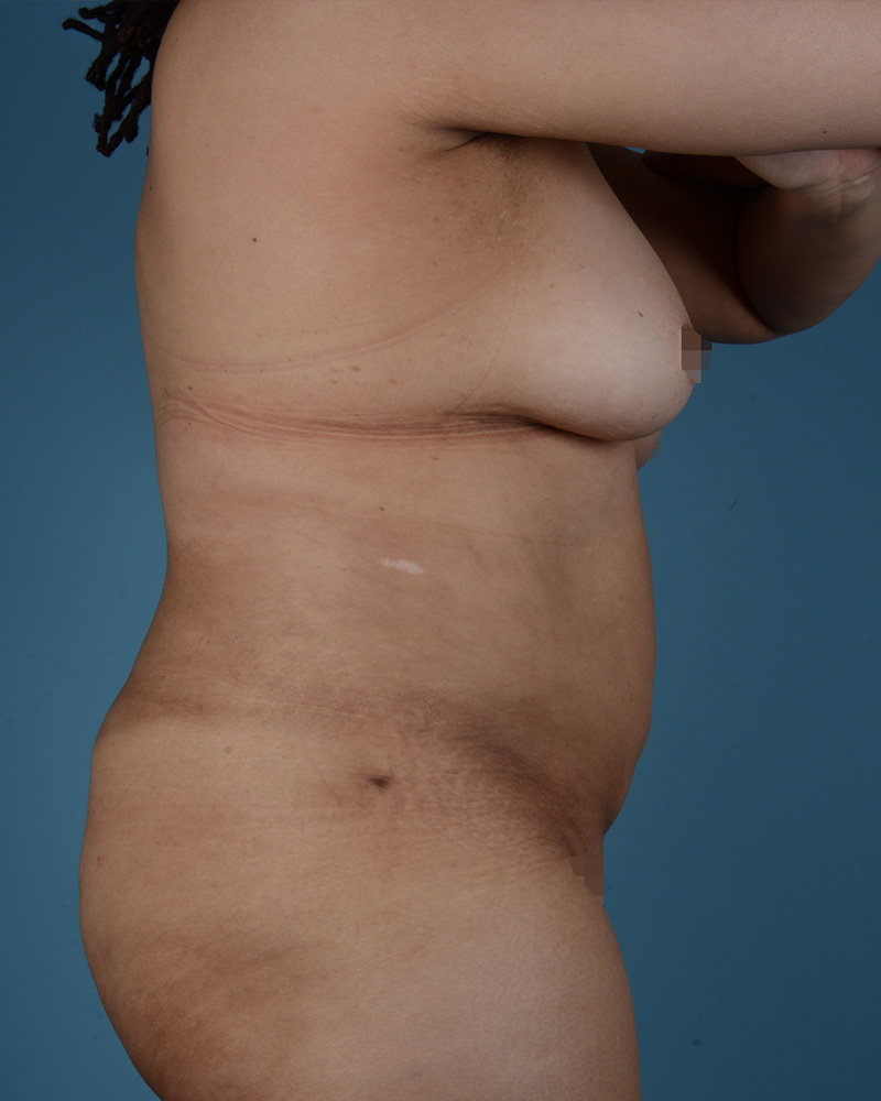 Liposuction Before and After | Dr. Thomas Hubbard