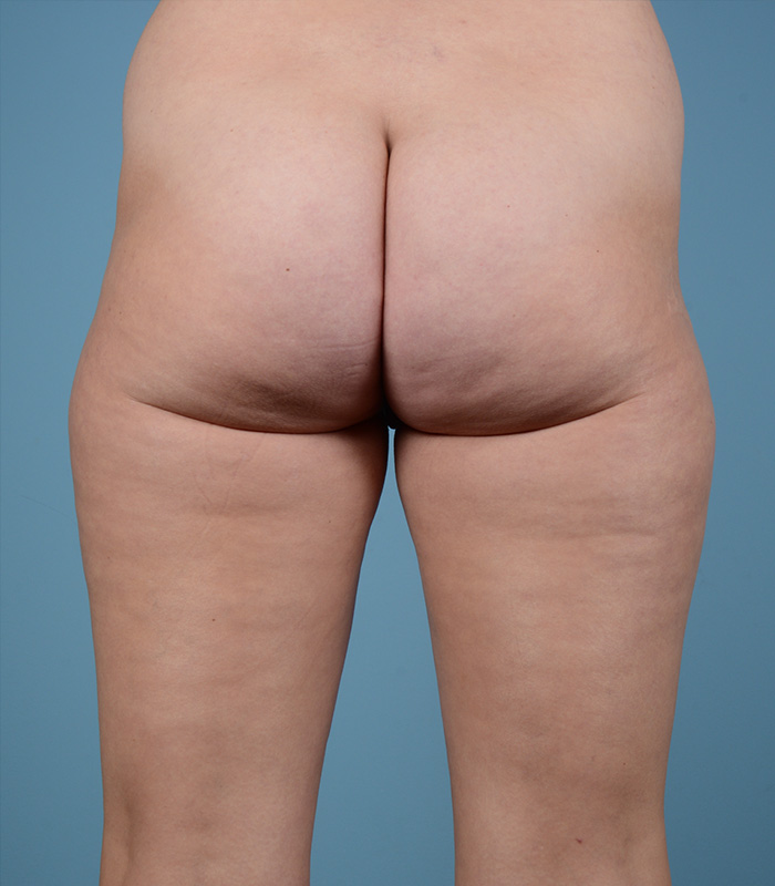 Liposuction Before and After | Dr. Thomas Hubbard