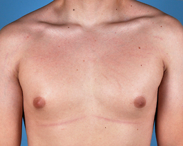 Male Breast Body Before and After | Dr. Thomas Hubbard