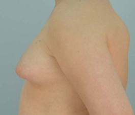 Male Breast Body Before and After | Dr. Thomas Hubbard