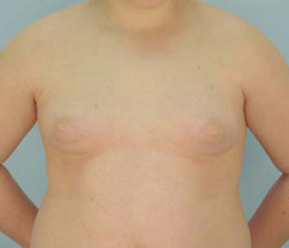 Male Breast Body Before and After | Dr. Thomas Hubbard