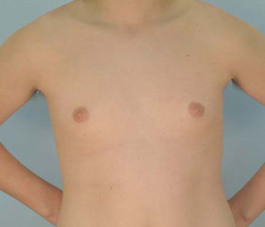 Male Breast Body Before and After | Dr. Thomas Hubbard