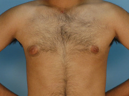 Male Breast Body Before and After | Dr. Thomas Hubbard