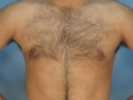 Male Breast Body Before and After | Dr. Thomas Hubbard