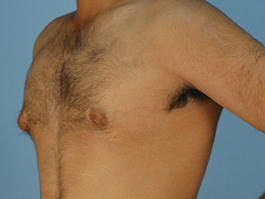 Male Breast Body Before and After | Dr. Thomas Hubbard