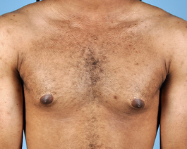 Male Breast Body Before and After | Dr. Thomas Hubbard