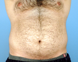 Male Breast Body Before and After | Dr. Thomas Hubbard