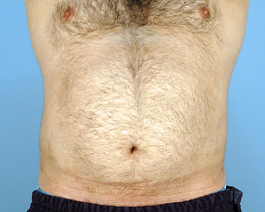 Male Breast Body Before and After | Dr. Thomas Hubbard