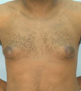 Male Breast Body Before and After | Dr. Thomas Hubbard