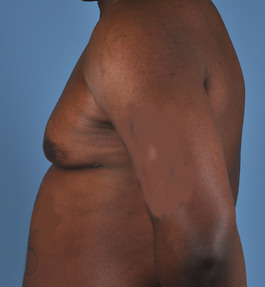 Male Breast Body Before and After | Dr. Thomas Hubbard