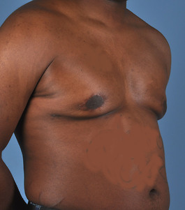 Male Breast Body Before and After | Dr. Thomas Hubbard