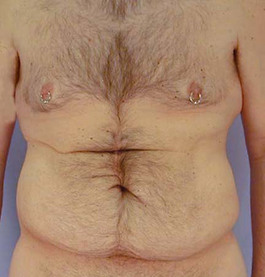 Male Breast Body Before and After | Dr. Thomas Hubbard