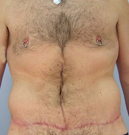 Male Breast Body Before and After | Dr. Thomas Hubbard