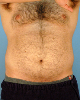 Male Breast Body Before and After | Dr. Thomas Hubbard