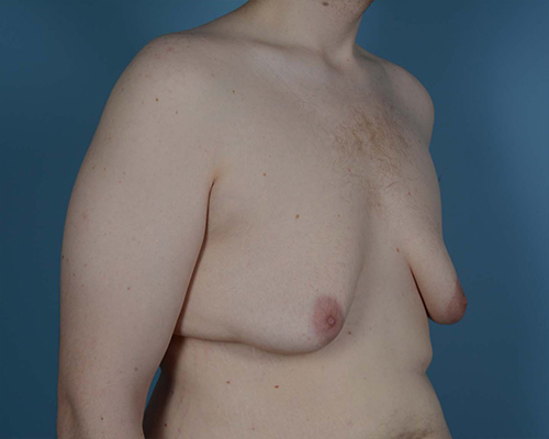 Male Breast Body Before and After | Dr. Thomas Hubbard