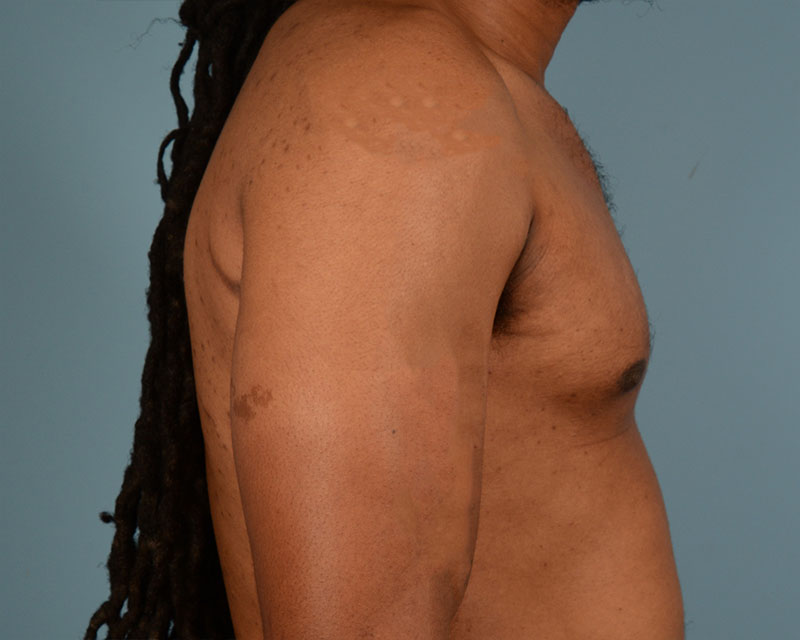 Male Breast Body Before and After | Dr. Thomas Hubbard