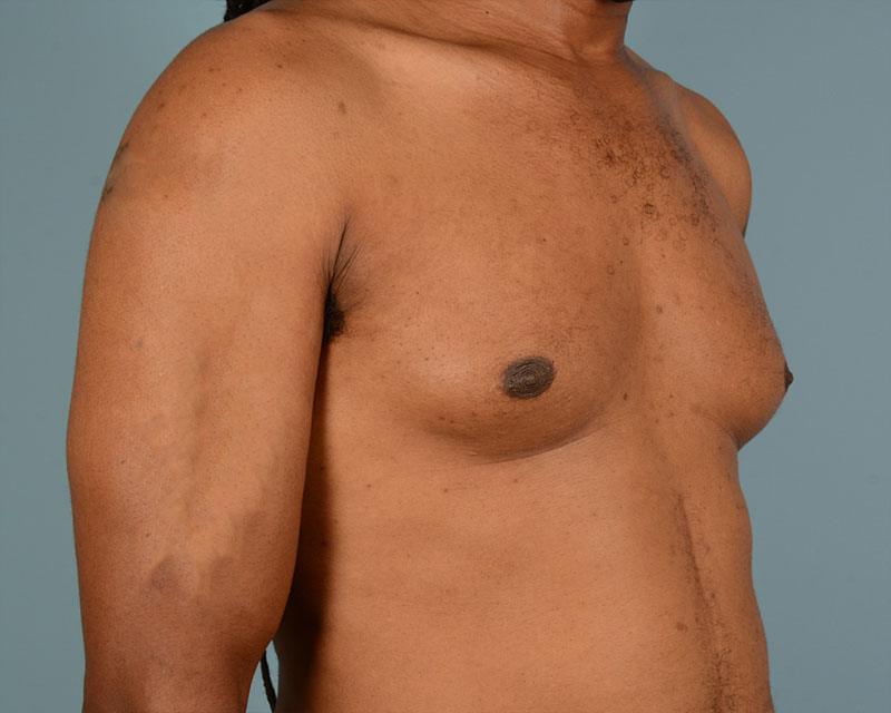 Male Breast Body Before and After | Dr. Thomas Hubbard