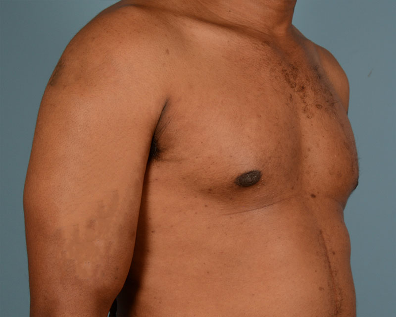 Male Breast Body Before and After | Dr. Thomas Hubbard