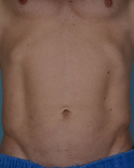 Male Breast Body Before and After | Dr. Thomas Hubbard