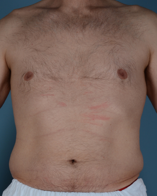 Male Breast Body Before and After | Dr. Thomas Hubbard