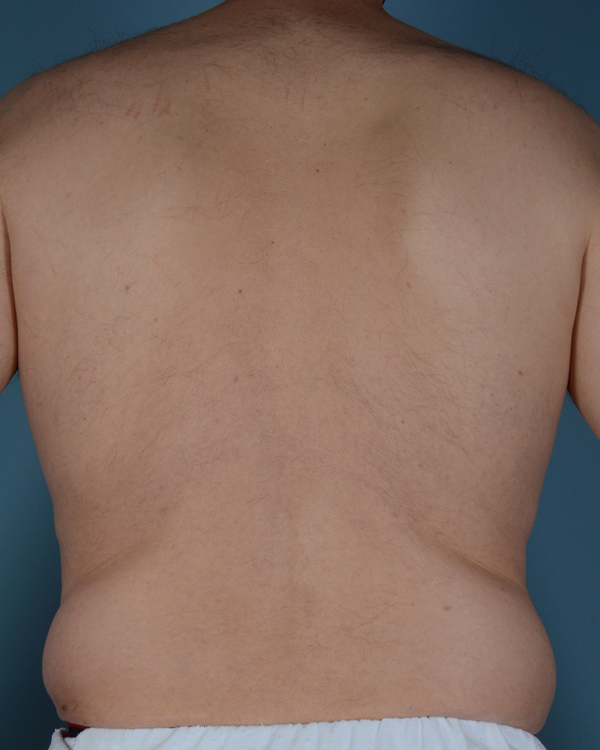 Male Breast Body Before and After | Dr. Thomas Hubbard