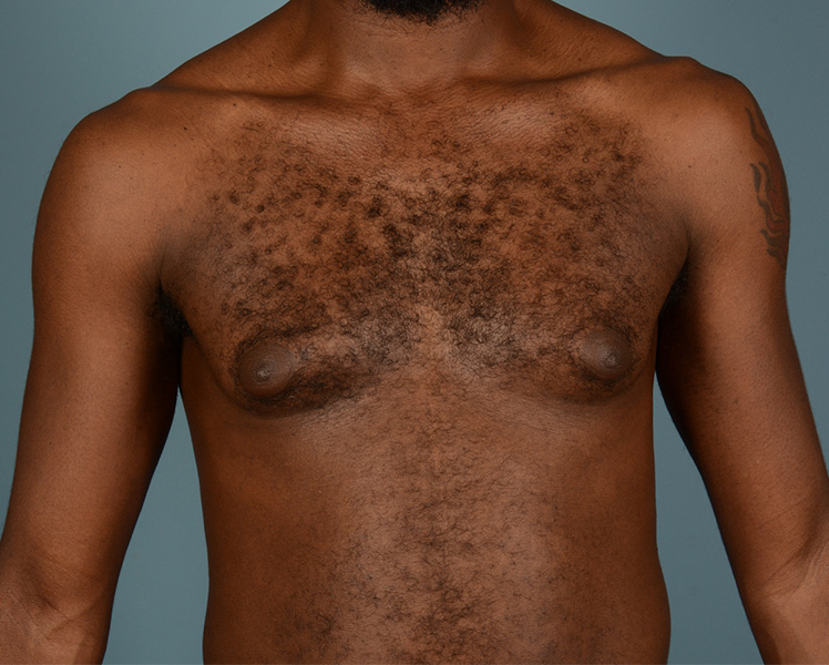 Male Breast Body Before and After | Dr. Thomas Hubbard