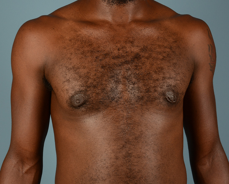 Male Breast Body Before and After | Dr. Thomas Hubbard