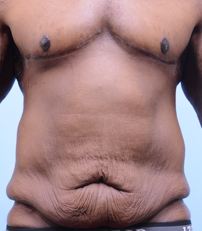 Male Breast Body Before and After | Dr. Thomas Hubbard