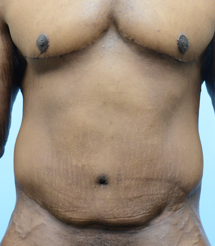 Male Breast Body Before and After | Dr. Thomas Hubbard