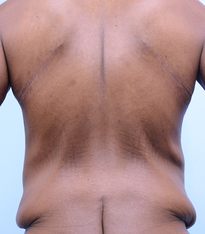 Male Breast Body Before and After | Dr. Thomas Hubbard