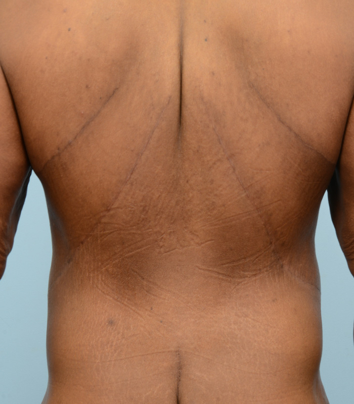 Male Breast Body Before and After | Dr. Thomas Hubbard