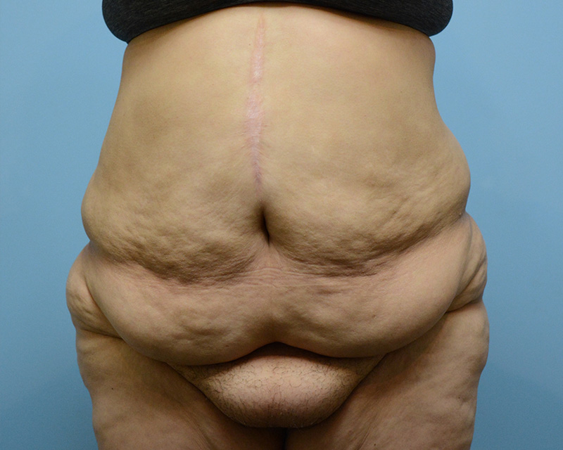 Surgery After Weight Loss Before and After | Dr. Thomas Hubbard
