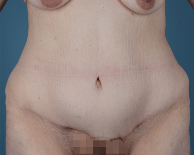 Surgery After Weight Loss Before and After | Dr. Thomas Hubbard