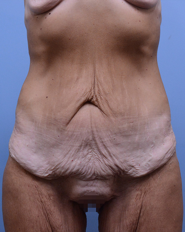 Surgery After Weight Loss Before and After | Dr. Thomas Hubbard