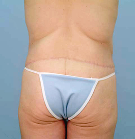 Thigh Lift Before and After | Dr. Thomas Hubbard