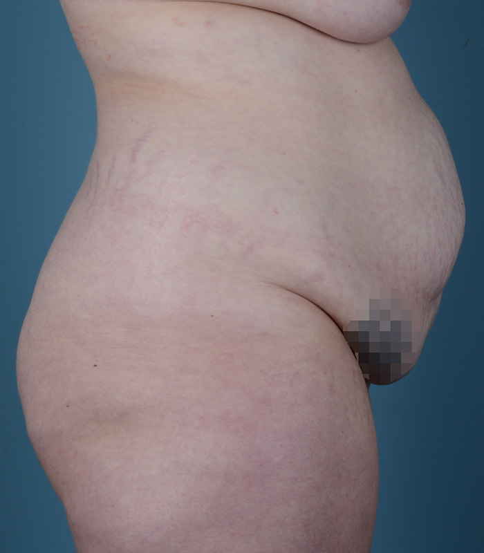 Tummy Tuck Before and After | Dr. Thomas Hubbard