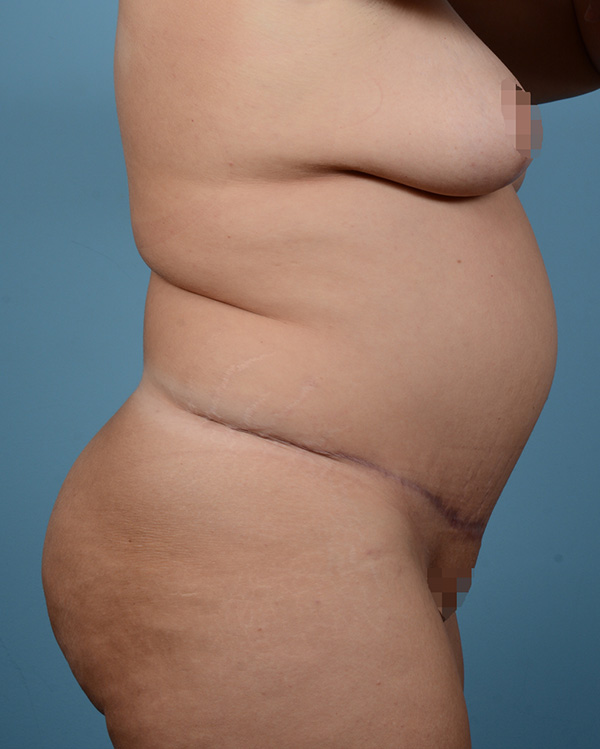 Tummy Tuck Before and After | Dr. Thomas Hubbard