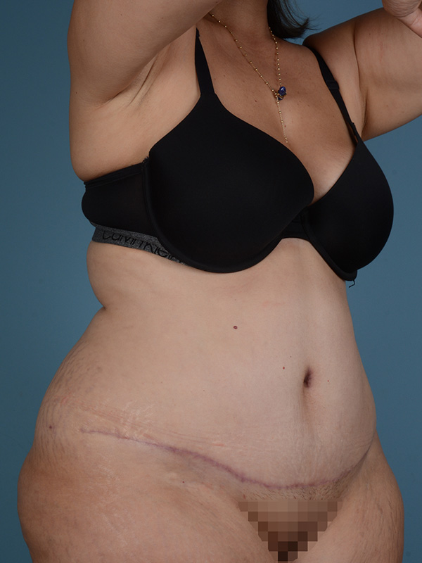 After Virginia Beach Abdominoplasty