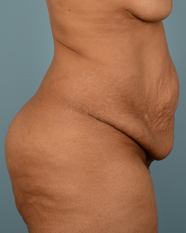 Tummy Tuck Before and After | Dr. Thomas Hubbard