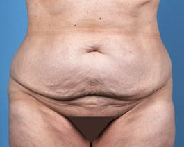 Tummy Tuck Before and After | Dr. Thomas Hubbard