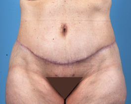 Tummy Tuck Before and After | Dr. Thomas Hubbard