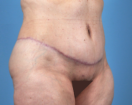 Tummy Tuck Before and After | Dr. Thomas Hubbard